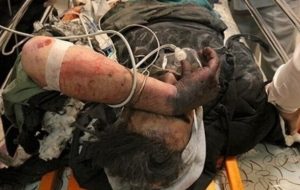 انفجار کیف حاوی مواد محترقه در قم باعث مصدومیت سه برادر شد