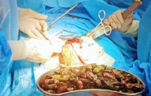 خارج کردن ۹۰ بسته مواد مخدر از معده یک فرد در کرج